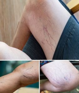 HT9. If you have purple veins on your legs, it means you are…